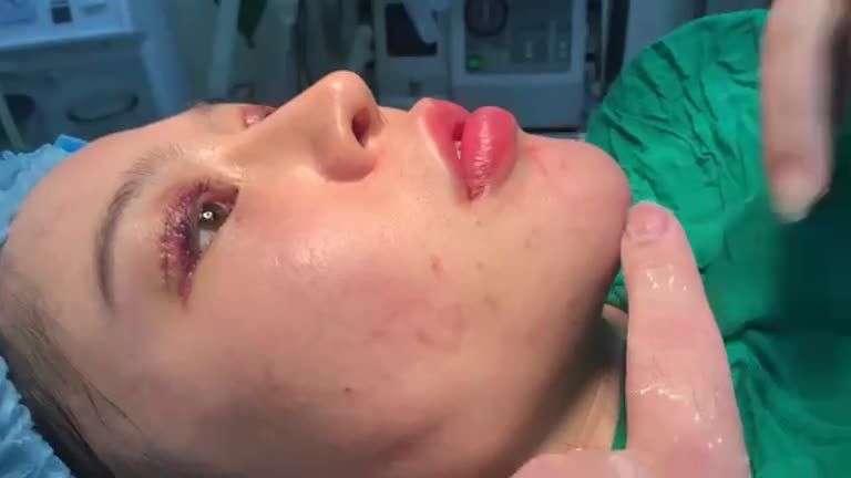 Độn cằm bầu bầu , U-line với Dr Vương